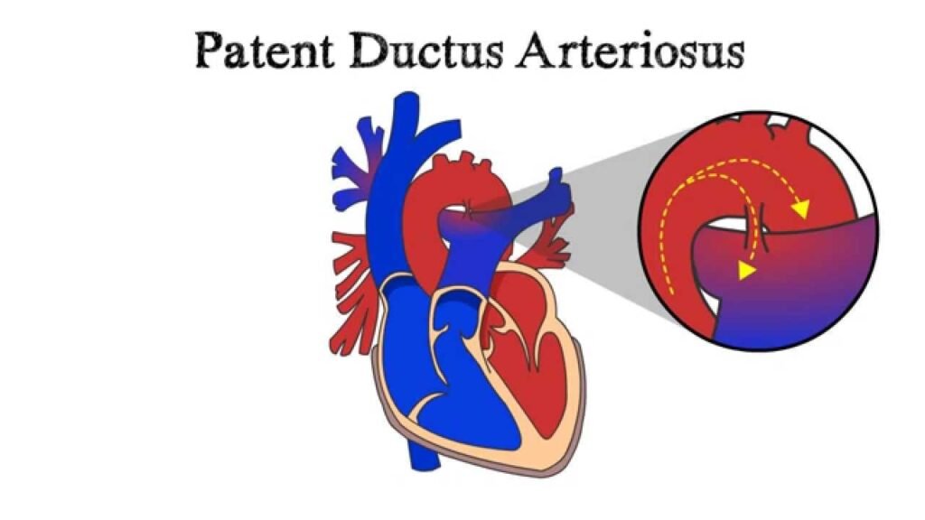 Healthier You | What is Patent Ductus Arteriosus(PDA)? - Healthier You