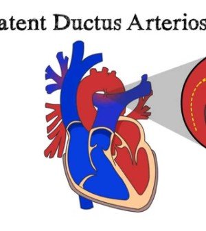 What is Patent Ductus Arteriosus(PDA)? - Healthier You